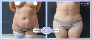Liposuction Before - After