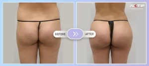 Butt Lift with Fat Injection