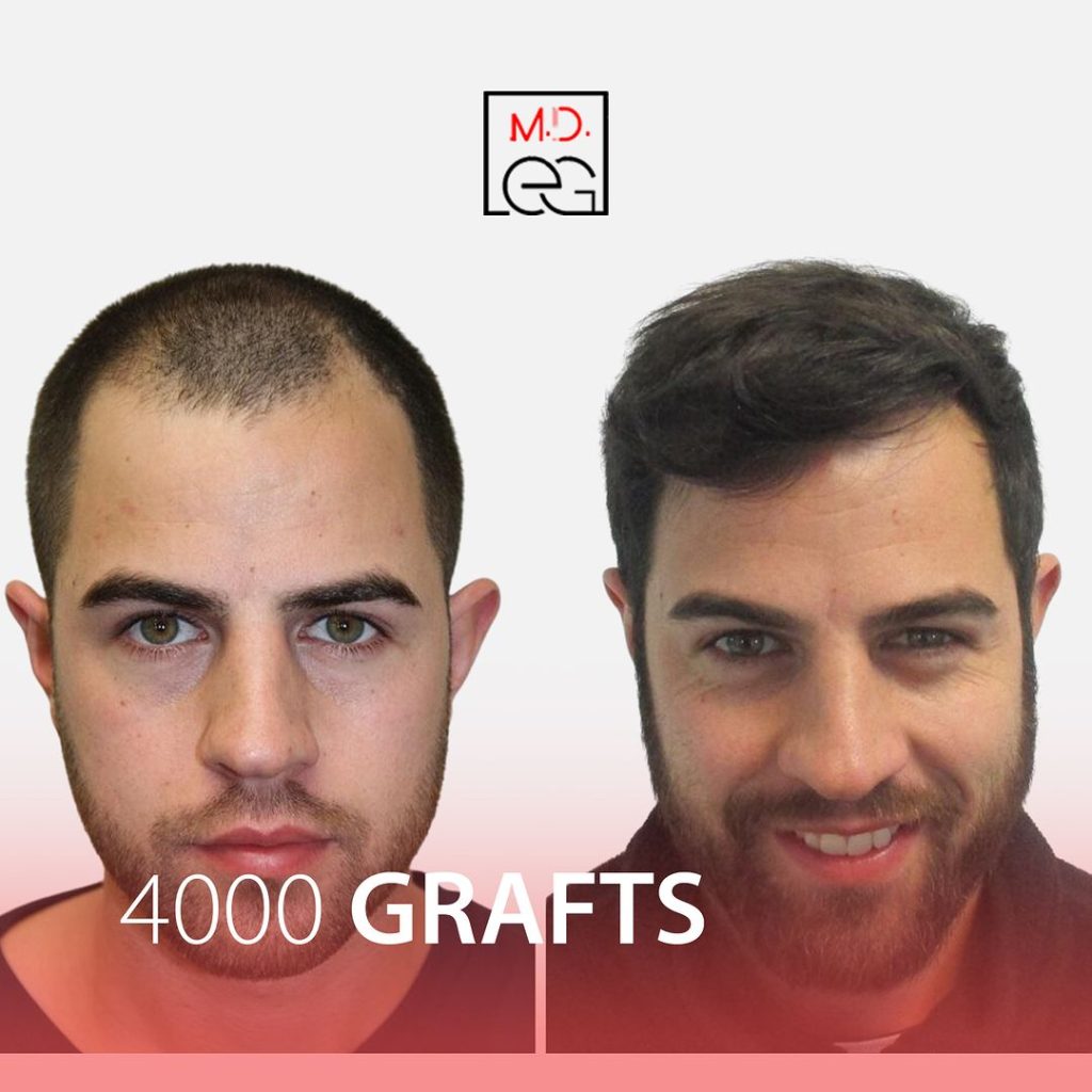 FUE Hair Transplantation Before - After
