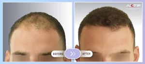 FUE Hair Transplantation Before - After