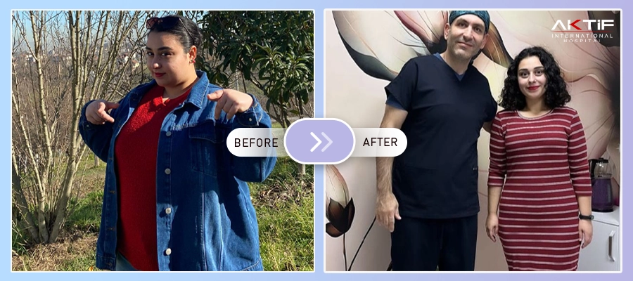 Gastric Sleeve Before - After