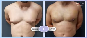 Gynecomastia Surgery Before - After