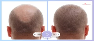 Hair Transplantation Before - After