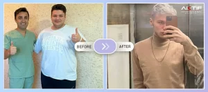 Mini Gastric Bypass Before - After