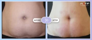 Stomach Botox Before - After