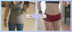 Swallowable Gastric Balloon Before - After