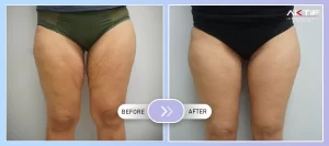 Thigh Lift Surgery