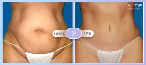 Belly Button Operation