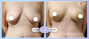 Breast Lift Before - After