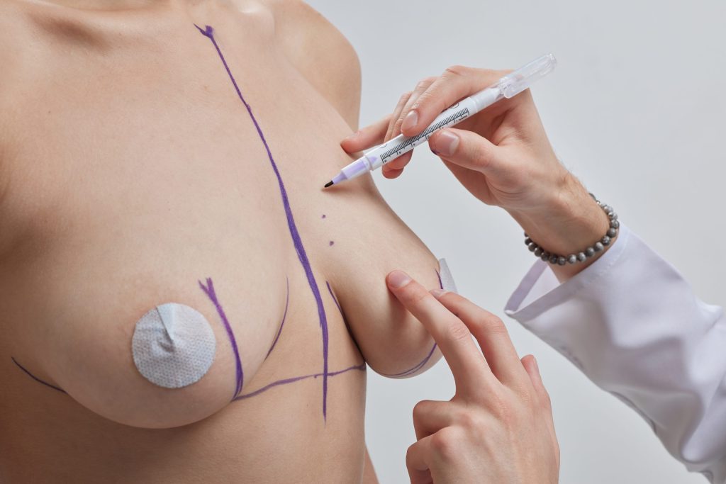 Breast Lift Surgery: Preparation before the surgery
