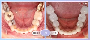 Dental Implant Before - After