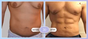 Six Pack Abs Surgery Before - After