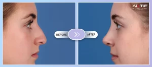 Tip Rinoplasty Before - After
