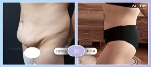 Tummy Tuck Before - After