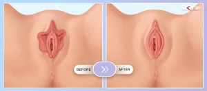 Vaginoplasty Before - After