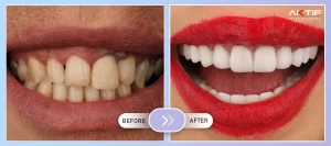 Zirconium Tooth Treatment Before - After