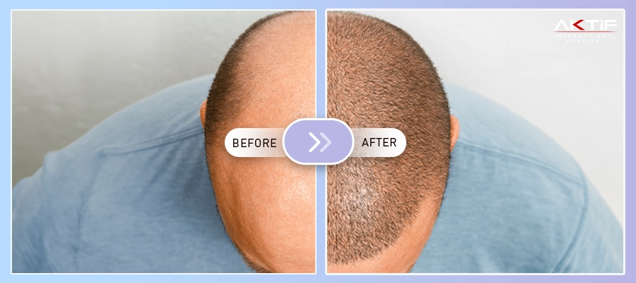 DHI Trasplante de Cabello Antes-Después