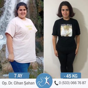 Chirurgie de bypass gastrique Avant-Après - 1