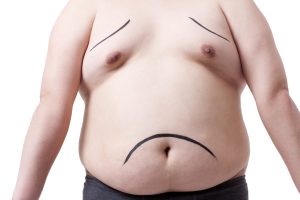 Chirurgie de la gynécomastie