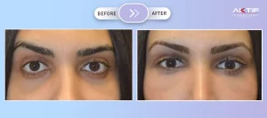 Esthétique des yeux d'amande Avant Après