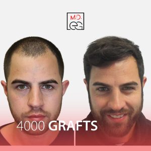 Greffe de cheveux FUE Avant-Après