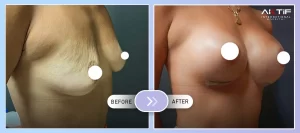 Chirurgie de remplacement des implants mammaires Avant-Après