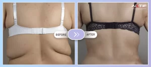 Chirurgie du lifting du dos Avant Après