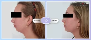 Esthétique du menton Avant Après