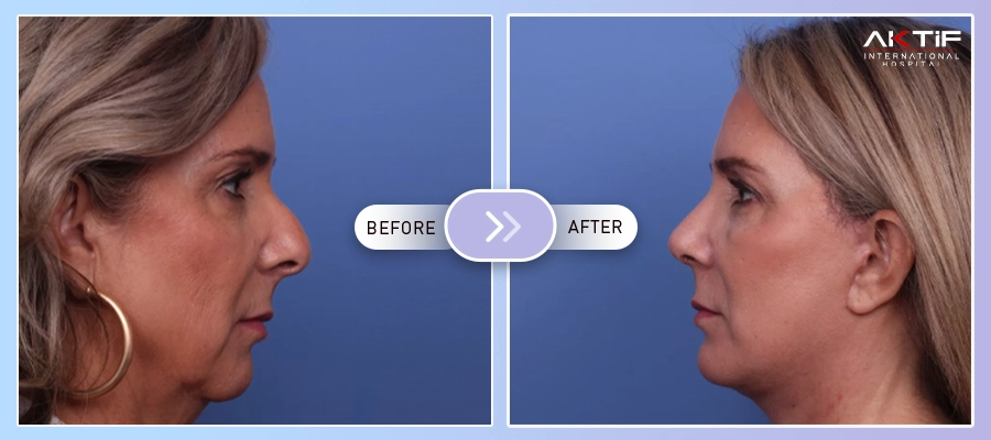 Operația de lifting facial înainte - după