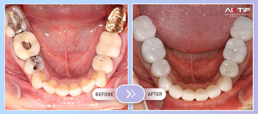 Implant dentar Înainte - După