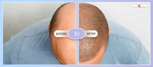 Пересадка волос DHI до и после (1)