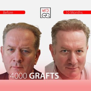 Пересадка волос методом DHI до и после (2)