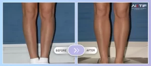 Имплантация икры до и после