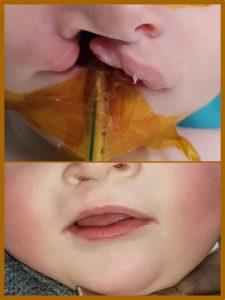Yarık Dudak Tedavisi (2)
